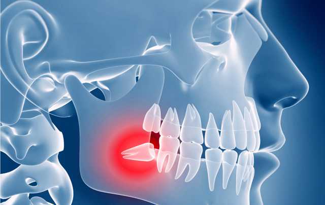 EXTRACTION & WISDOM TOOTH REMOVAL
